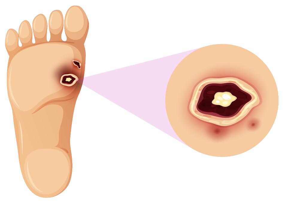 Diabetic foot