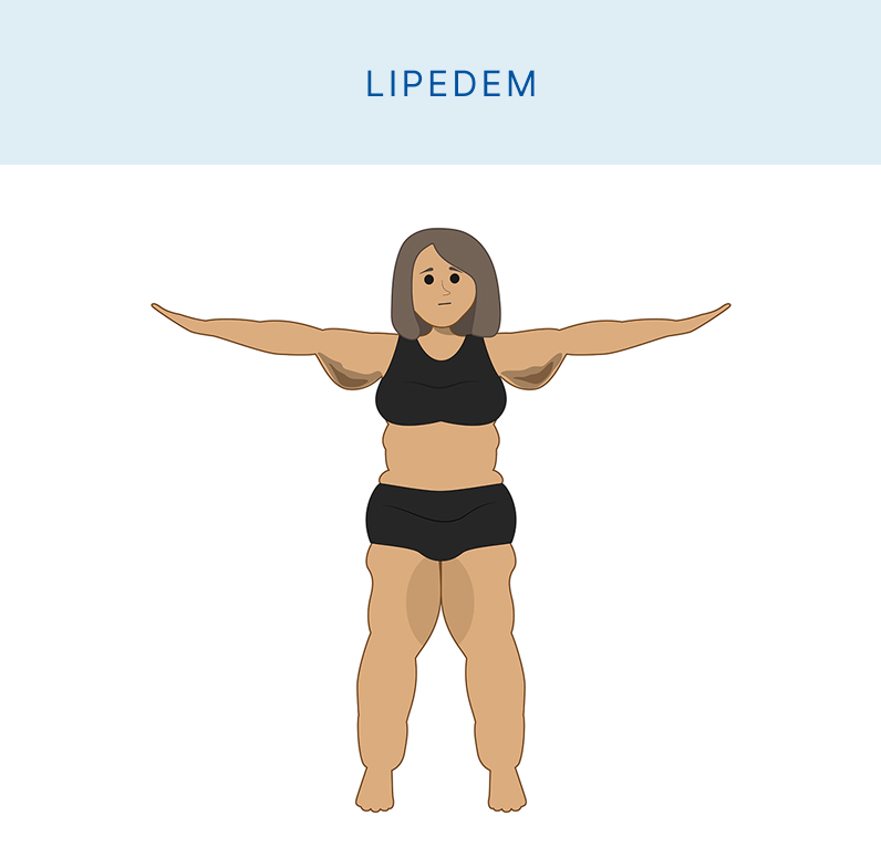 Lipedem