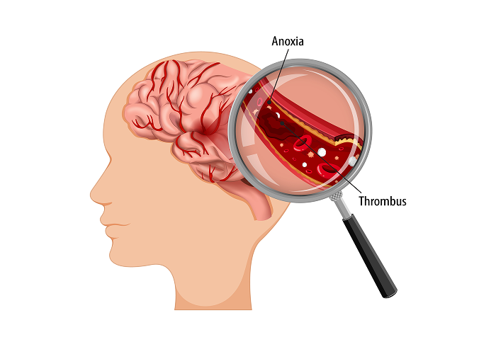 Neurologie 4